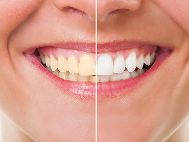 Teeth Whitening in Humble, TX - Cosmetic Dentist in Humble